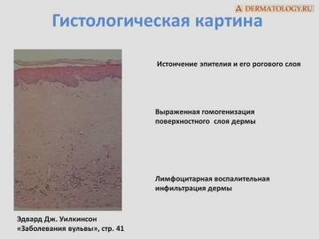 Гистологическая картина. Заболевания вульвы